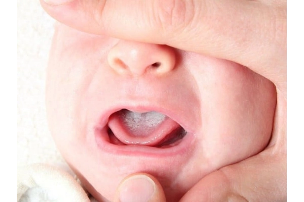 Giới thiệu về hiện tượng lưỡi bị trắng ở trẻ sơ sinh