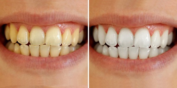 Tẩy trắng răng là gì? Tổng quan về tẩy trắng răng