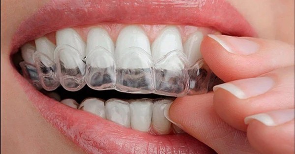 Thời điểm phù hợp tẩy trắng răng sau sinh an toàn cho mẹ và bé