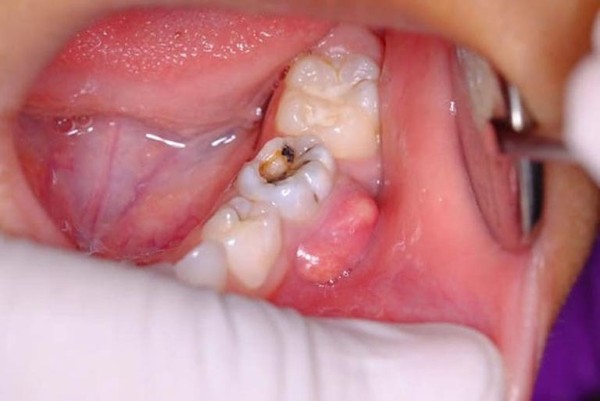 Dấu hiệu nhận biết răng khôn mọc lệch làm áp xe quanh chân răng khôn