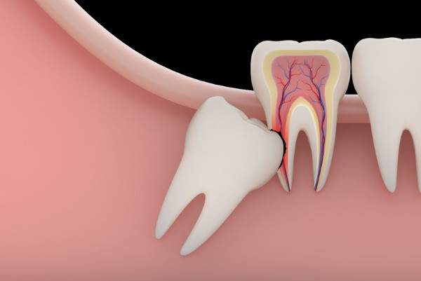 Dấu hiệu răng khôn mọc lệch có thể dẫn đến nhiều biến chứng nghiêm trọng