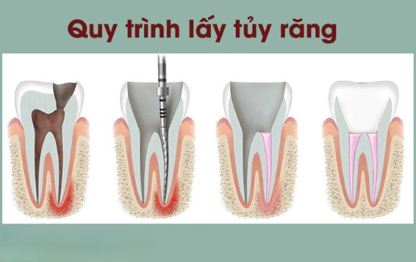 Lấy tủy răng bao nhiêu tiền? Bảng giá mới nhất năm 2025 2 Quy trình lấy tủy răng tiêu chuẩn