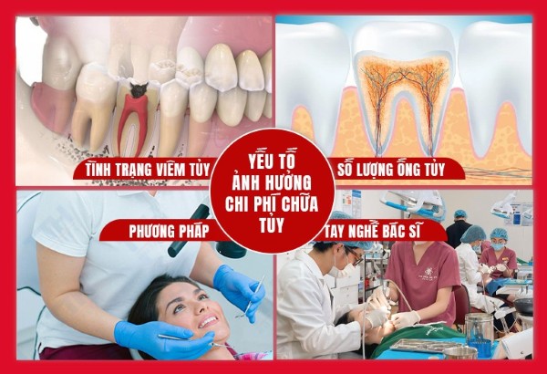 Lấy tủy răng bao nhiêu tiền? Bảng giá mới nhất năm 2025 3 Các yếu tố quyết định lấy tủy răng bao nhiêu tiền