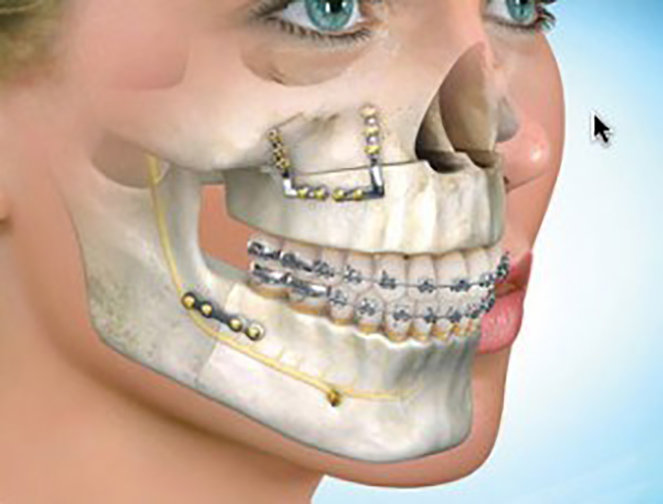 Phẫu thuật chỉnh hình xương hàm