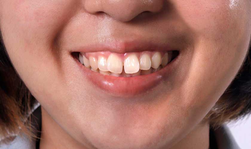 Những điều cần lưu ý khi điều trị răng vẩu