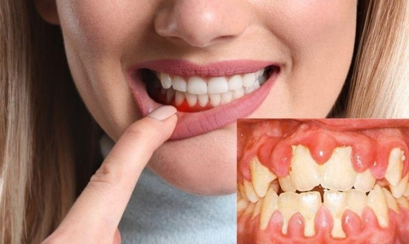 Sưng nướu răng Dấu hiệu, nguyên nhân và cách điều trị hiệu quả