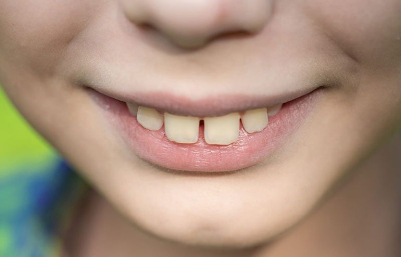 Có bao nhiêu loại răng vẩu?
