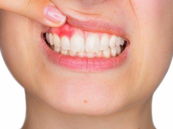 Câu hỏi thường gặp về sưng chân răng