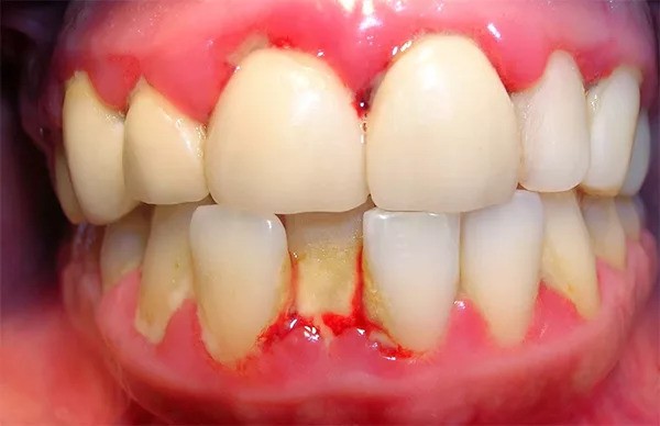 Viêm nhiễm răng miệng là nguyên nhân dẫn đến sưng chân răng