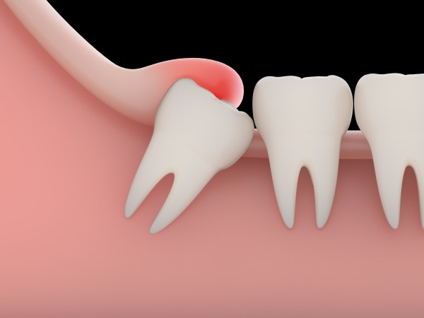 Răng khôn và răng lệch vị trí dẫn đến tình trạng sưng chân răng