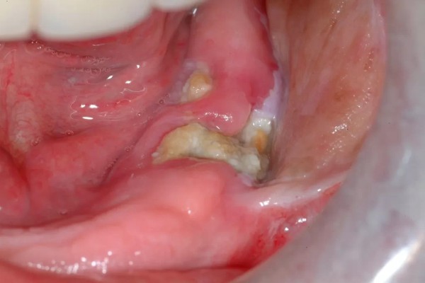 Sưng chân răng do nhiễm trùng nấm, virus trong miệng
