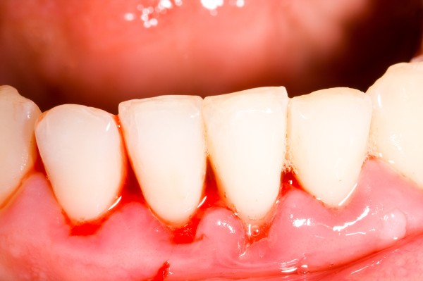 Triệu chứng và dấu hiệu nhận biết khi bị sưng chân răng