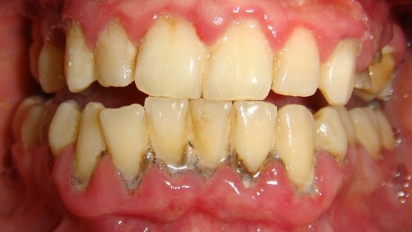 Tình trạng sưng chân răng dẫn đến biến chứng khi không điều trị kịp thời