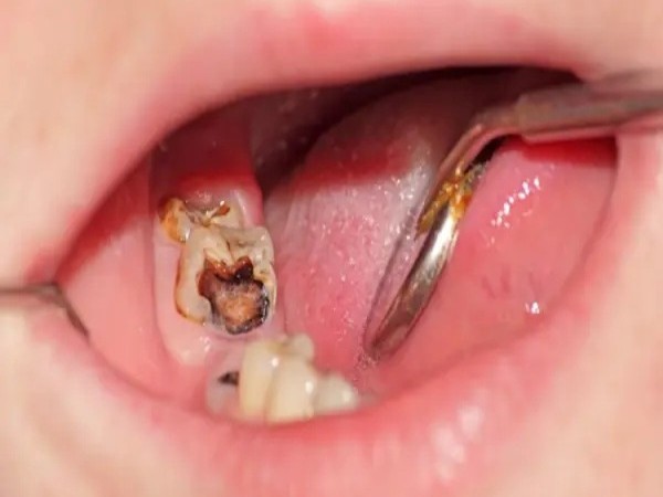 Tình trạng răng cần lấy tủy khi trám răng sâu
