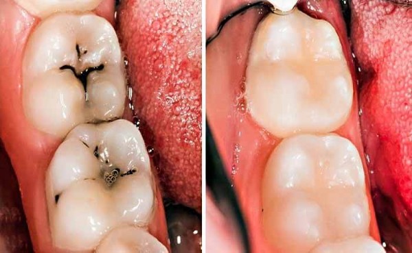 Răng trám không cần lấy tủy