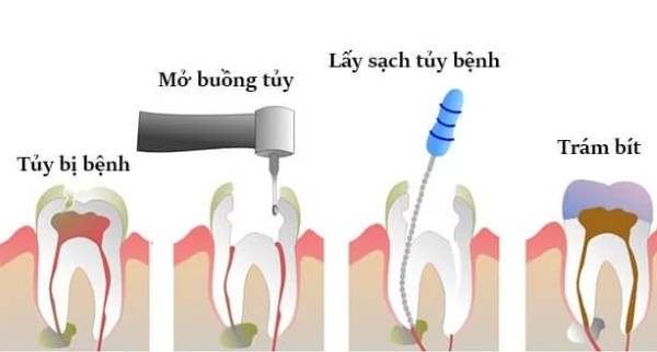 Quy trình thực hiện trám răng kết hợp lấy tủy