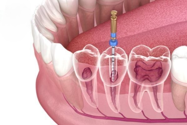 Ưu và nhược điểm của việc lấy tủy trước khi trám răng