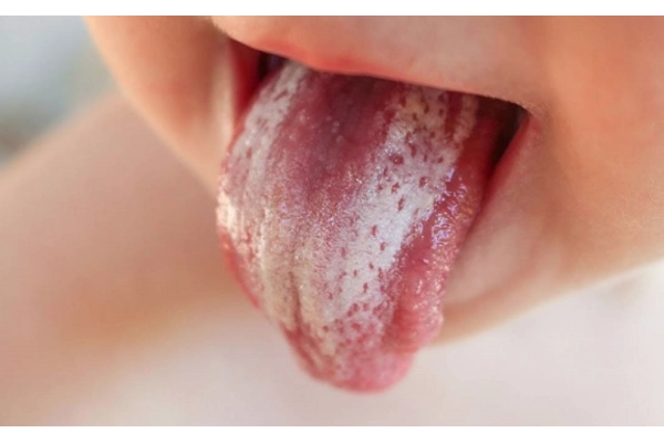 Khái quát về bệnh nấm lưỡi ở trẻ nhỏ