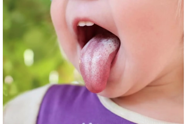 Triệu chứng nhận biết trẻ bị nấm lưỡi
