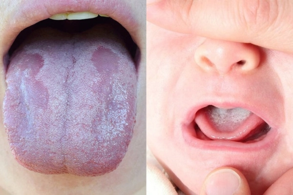 Phân biệt nấm lưỡi với cặn sữa