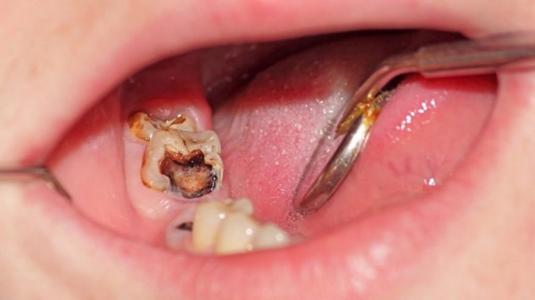 Viêm tủy răng là tình trạng viêm nhiễm của mô tủy bên trong răng