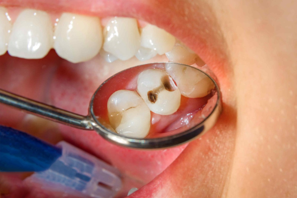 Các trường hợp được áp dụng giảm đau tại nhà khi bị viêm tủy răng