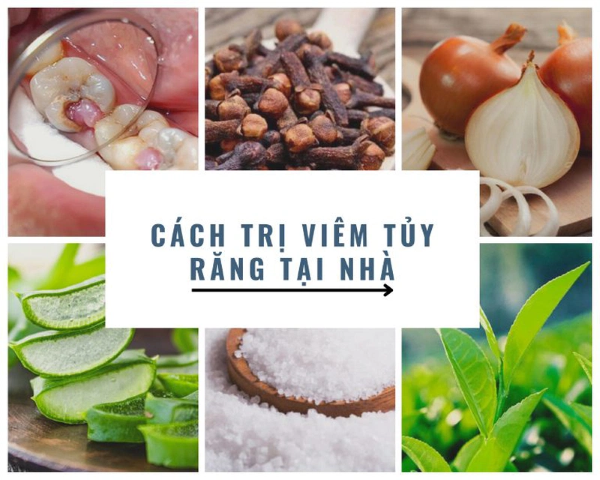 Những lưu ý khi áp dụng các phương pháp điều trị viêm tủy răng tại nhà