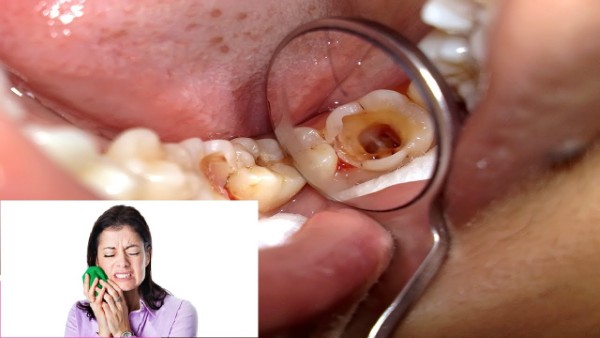 Các thắc mắc thường gặp về việc điều trị viêm tủy răng tại nhà