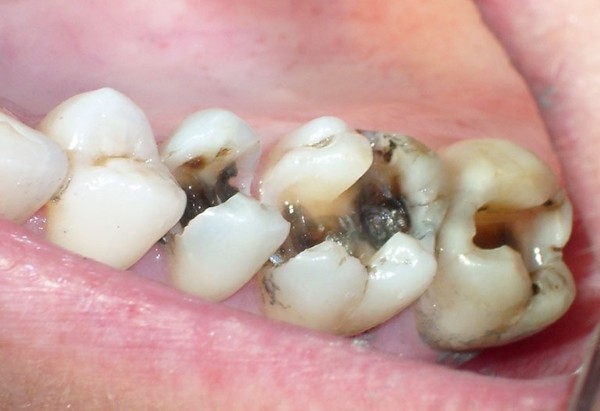 Triệu chứng nhận biết tủy răng bị thối