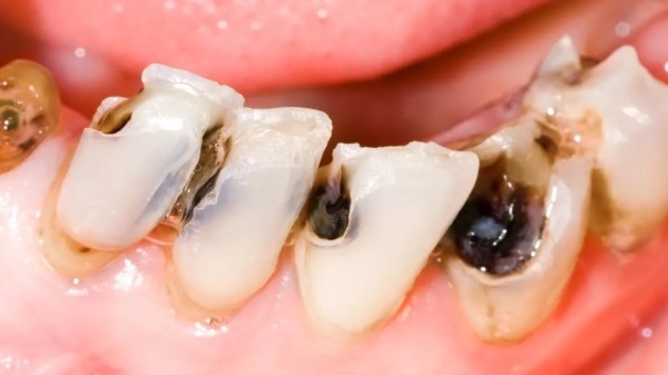 Những biến chứng khi tủy răng bị thối không được điều trị