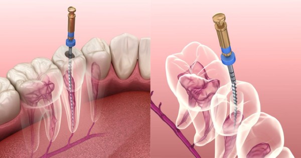 Phương pháp điều trị tủy răng bị thối