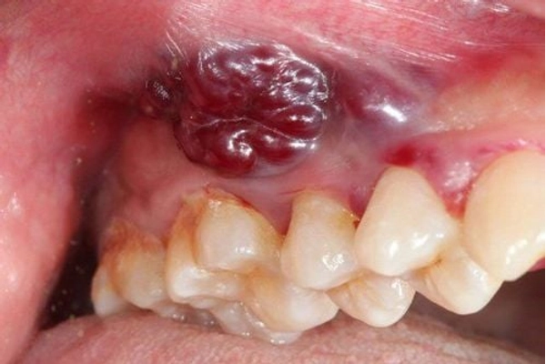 Tổng quan về ung thư nướu răng