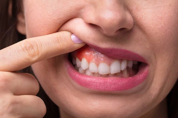 Triệu chứng nhận biết và dấu hiệu cảnh báo sớm về ung thư nướu răng