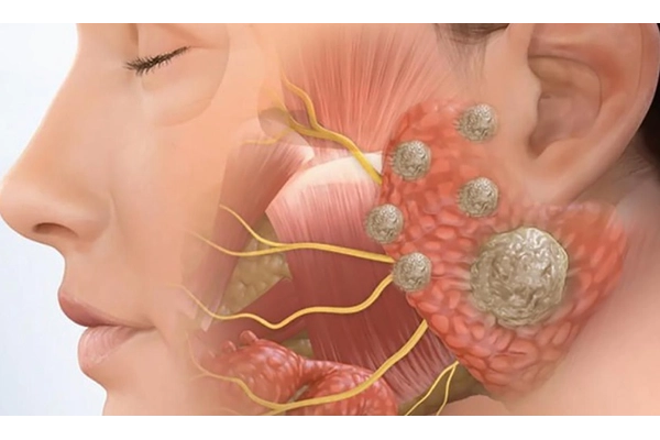 Tổng quan về bệnh ung thư xương hàm