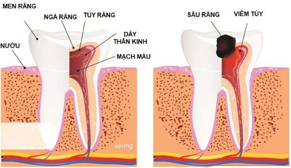Tổng quan về tủy răng và bệnh viêm tủy răng