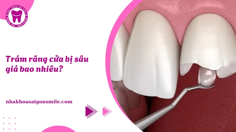 Trám răng cửa bị sâu giá bao nhiêu? Bảng giá mới nhất 2025