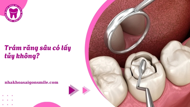 Trám răng sâu có lấy tủy không​? Khi nào nên lấy tủy