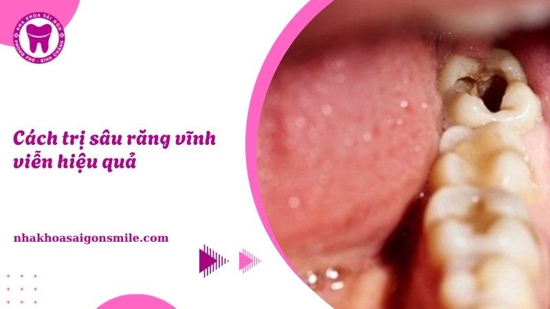 Cách trị sâu răng vĩnh viễn​ hiệu quả, ngăn ngừa tái phát tại nhà