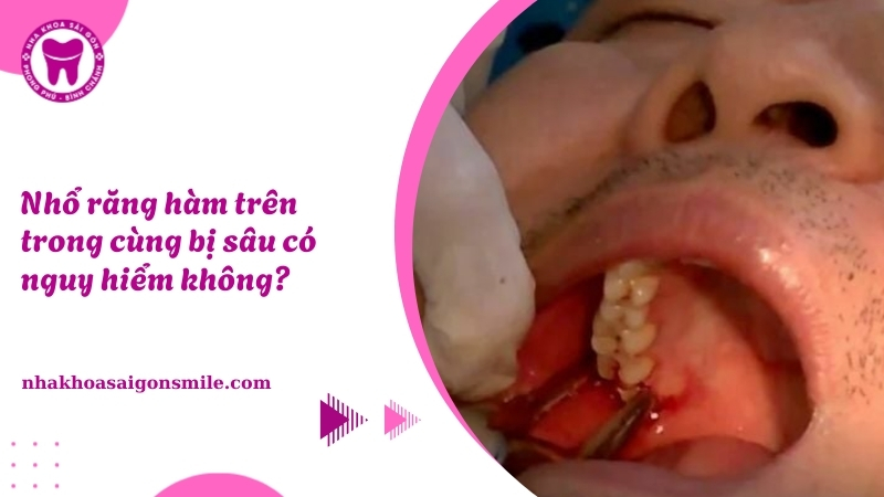 189. Nho rang ham tren trong cung bi sau​ co nguy hiem khong