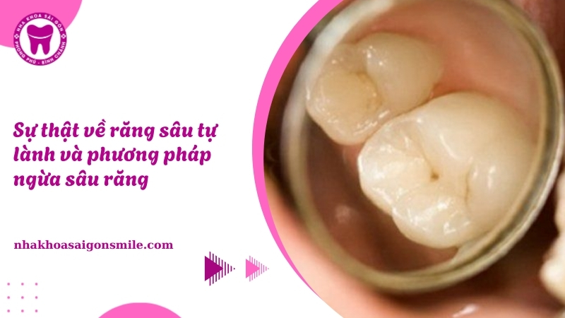 191. Su that ve rang sau tu lanh va phuong phap ngua sau rang
