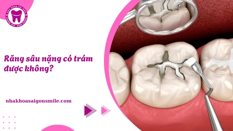 194. Rang sau nang co tram duoc khong​ Cach dieu tri hieu qua nhat