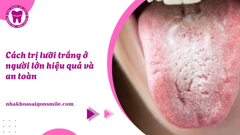 210. Cach tri luoi trang o nguoi lon hieu qua va an toan