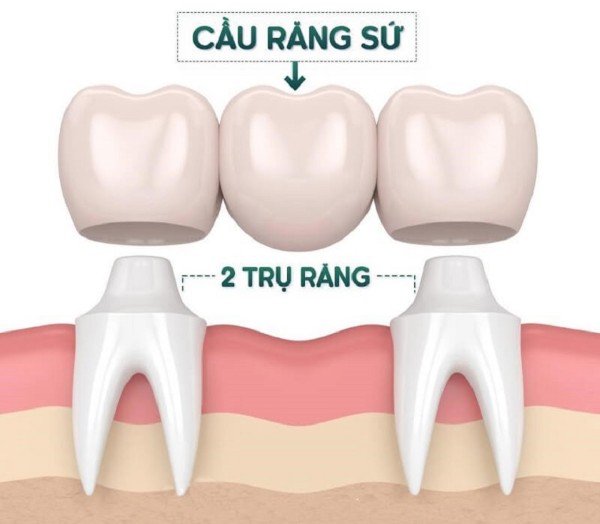Cầu răng sứ là gì? Hướng dẫn chi tiết từ A đến Z cho người mới 8 Cầu răng sứ là một phương pháp phục hình răng