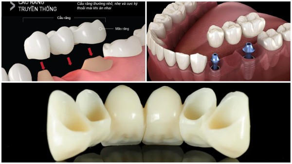 Cầu răng sứ là gì? Hướng dẫn chi tiết từ A đến Z cho người mới 10 Các loại cầu răng sứ phổ biến hiện nay