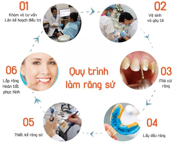 Cầu răng sứ là gì? Hướng dẫn chi tiết từ A đến Z cho người mới 12 Quy trình thực hiện cầu răng sứ tại nha khoa
