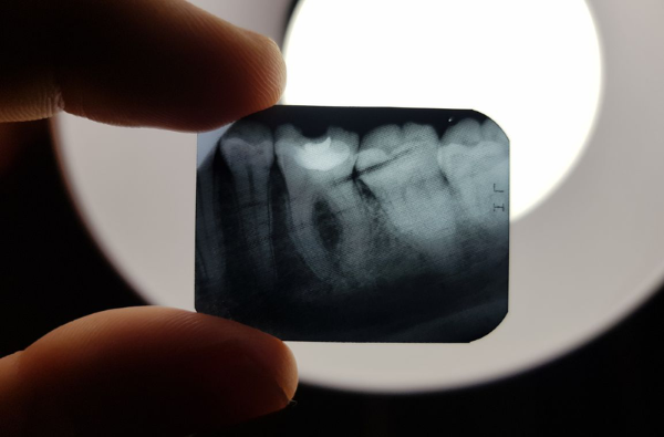 Chụp X Quang bao nhiêu tiền? Nên chụp x quang răng ở đâu? 13 Chụp X quang răng cận chóp