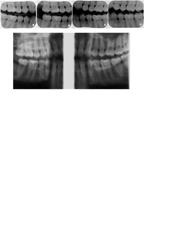 Chụp X Quang bao nhiêu tiền? Nên chụp x quang răng ở đâu? 14 Chụp X quang cánh cắn