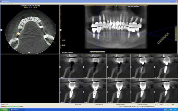 Chụp X Quang bao nhiêu tiền? Nên chụp x quang răng ở đâu? 16 Chụp cắt lớp vi tính Cone Beam 3D