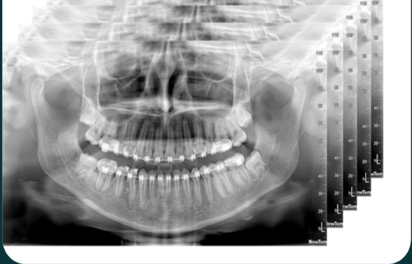 Chụp X Quang bao nhiêu tiền? Nên chụp x quang răng ở đâu? 17 Các kỹ thuật chụp quang tuyến toàn hàm