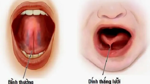 Dính thắng lưỡi là gì?